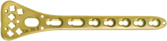 Багатоканальна променева дистальна блокуюча пластина, ЕЙЧ БІ ОРТО